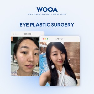 WOOA PROMOTION 1 페이지 - WOOA Plastic Surgery & Dermatology